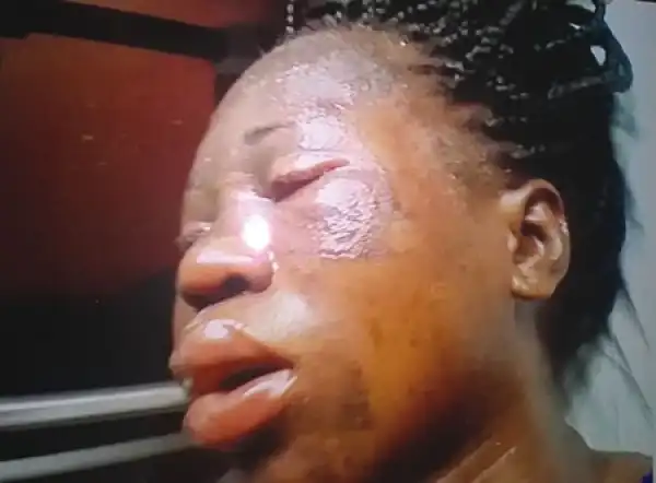 Photo: Woman Bathed With Hot Oil In Lagos Loses Pregnancy
